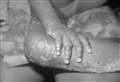 First recorded case of Monkeypox confirmed in Scotland