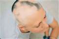 First alopecia treatment approved for NHS use