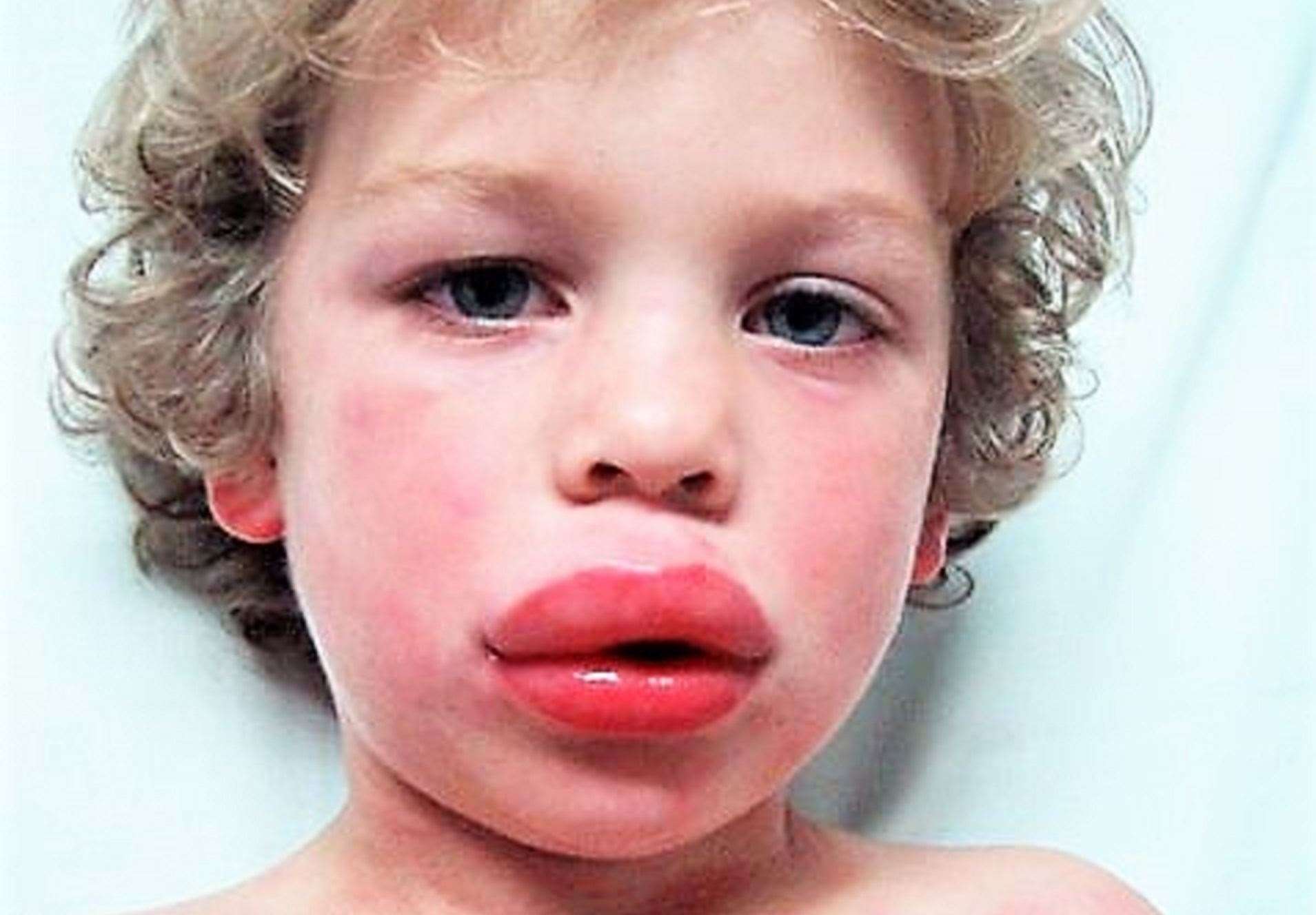 A boy suffering from the effects of anaphylaxis showing a rash and swelling of the lips.